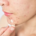Sulfur-based Treatments for Cystic Acne: A Comprehensive Overview
