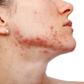 The Effects of Stress on Cystic Acne