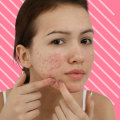 Exercise to Reduce Inflammation from Cystic Acne
